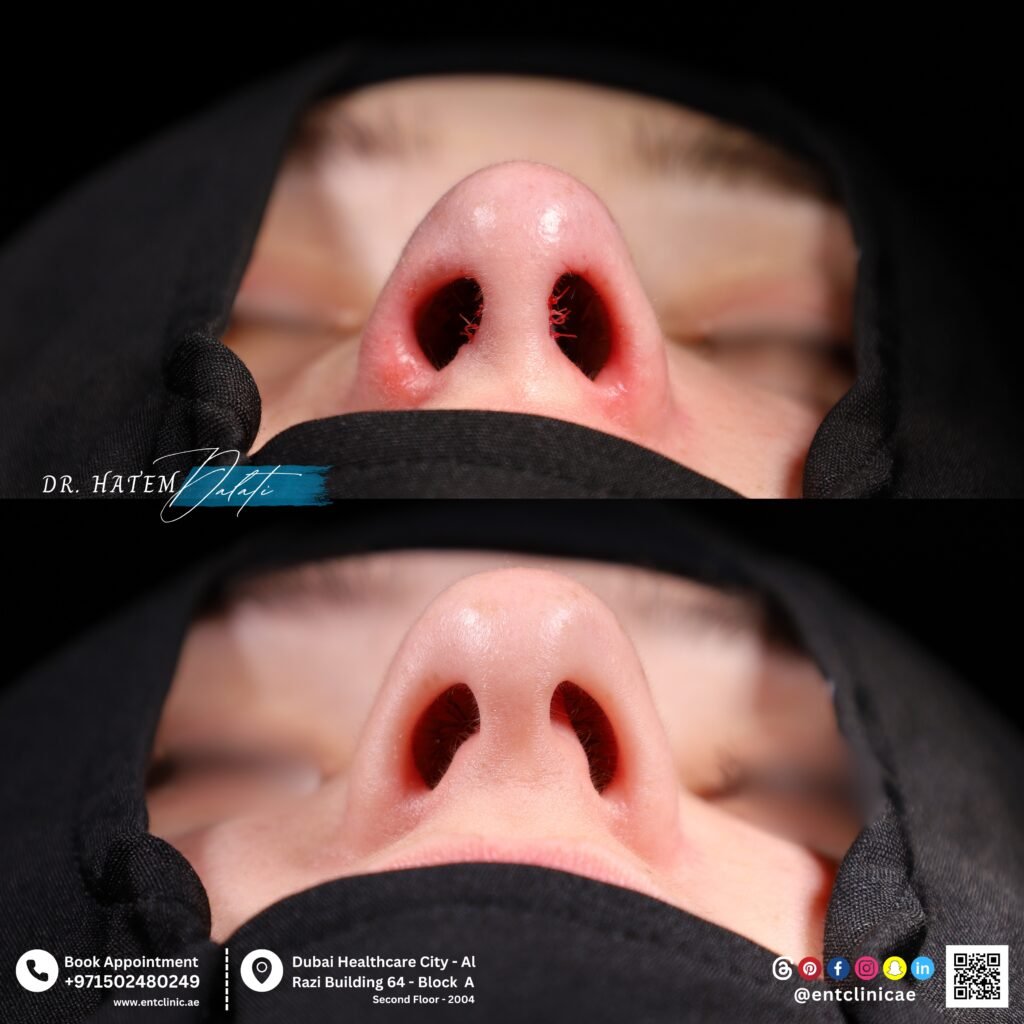 No external incisions — all changes are made internally, leaving the skin surface completely scar-free while improving shape and function.