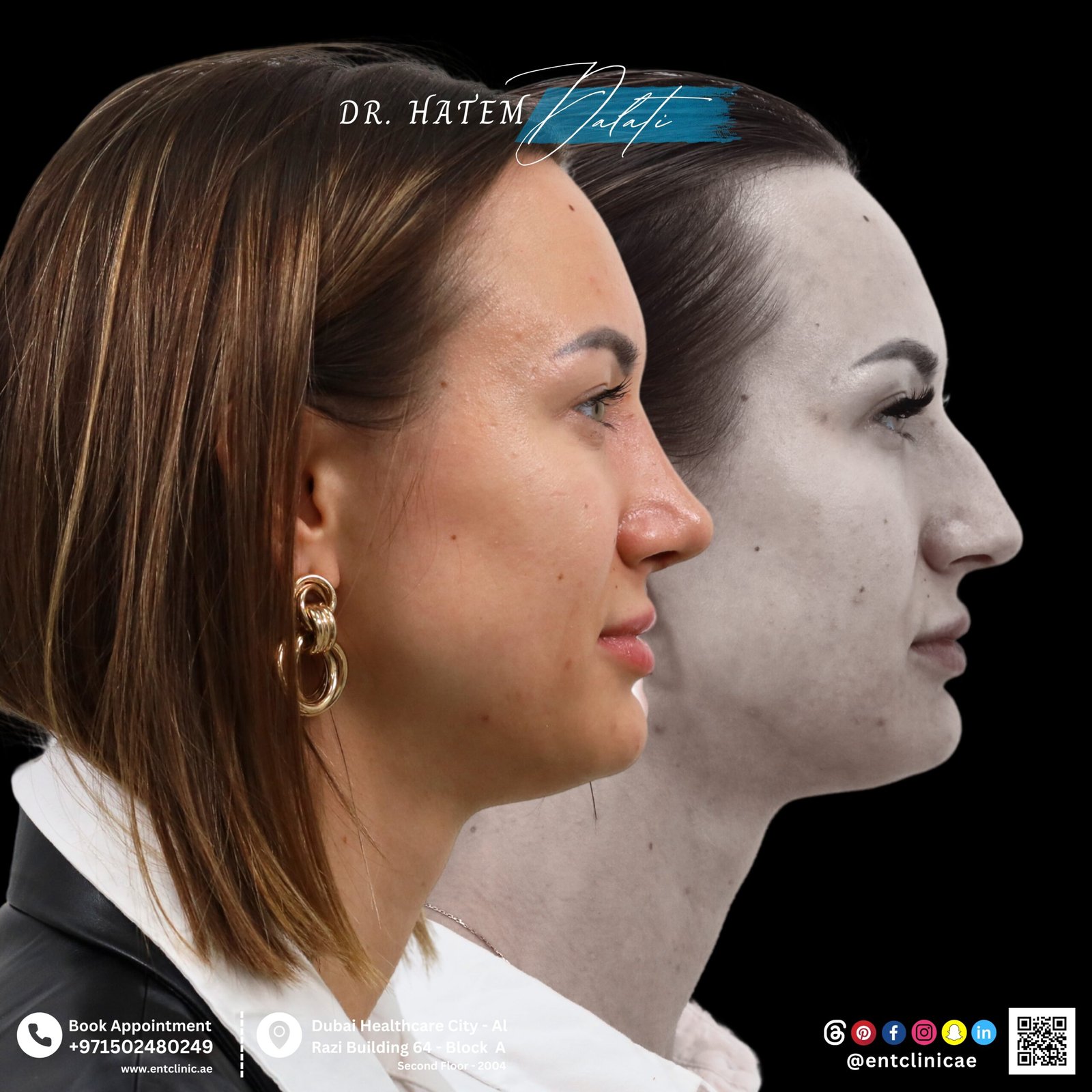 DR HATEM DALATI RHINOPLASTY NOSE JOB REVISION DUBAI UAE NATURAL LOOK PRICE ENT CONSULTANT SURGEON SURGERY