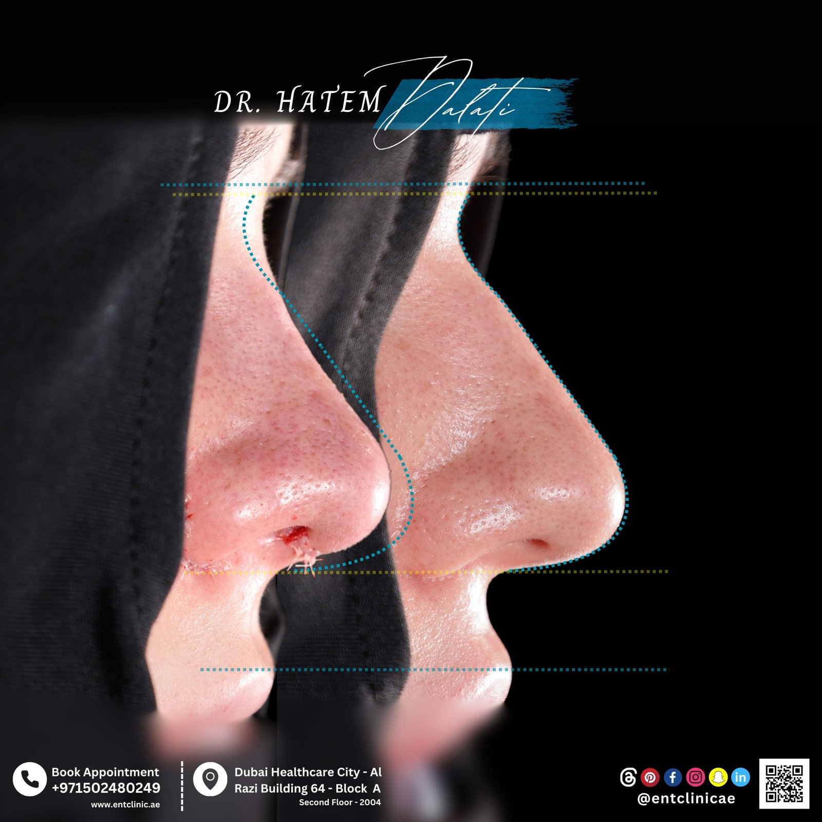 قبل وبعد تجميل الأنف للبشرة السميكة في دبي
