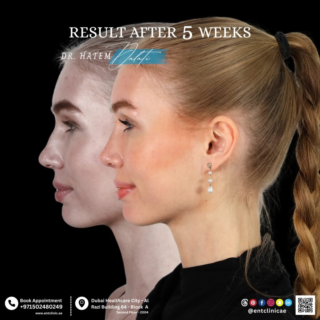 Rhinoplasty in Dubai before and after results showing natural nose reshaping and improved facial harmony