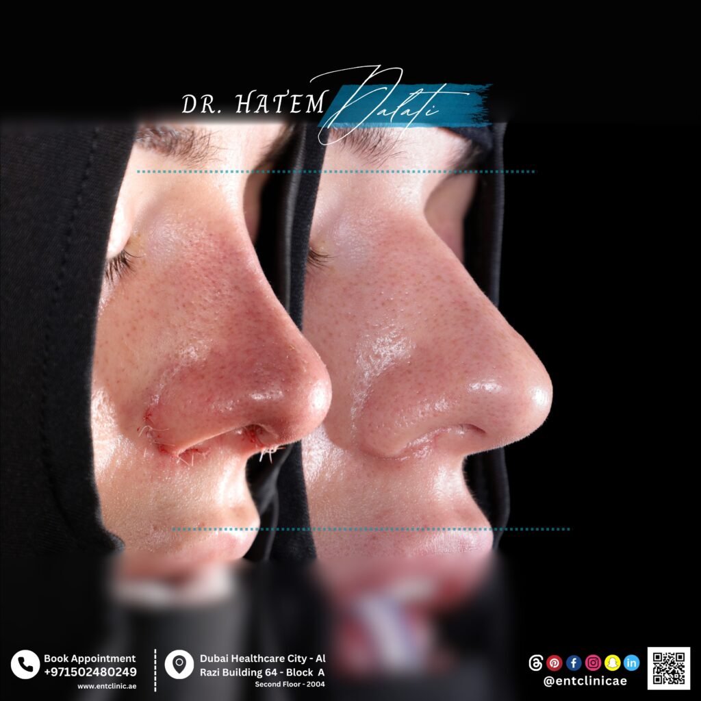 Before and after thick skin rhinoplasty showing improved nasal tip definition and refined profile in a patient with dense nasal skin