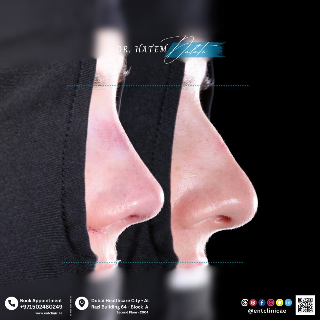 Before and after rhinoplasty showing natural results and improved nasal contour in Dubai
