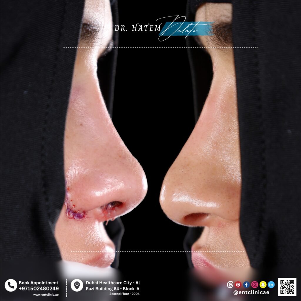 revision rhinoplasty results after nasal adhesion complication treatment in Dubai