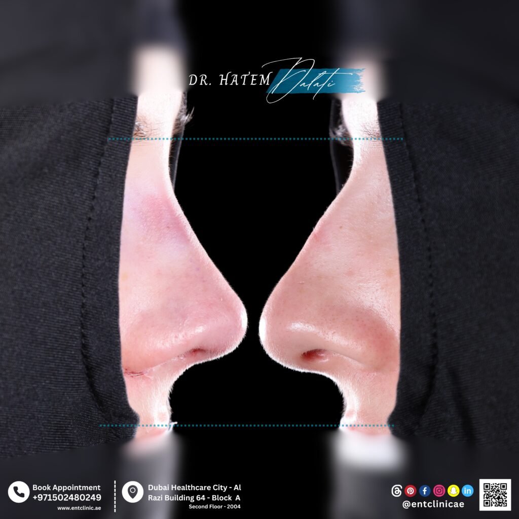 Before and after closed rhinoplasty showing a common type of rhinoplasty with natural nose refinement, improved bridge and tip definition, and no visible external scars.