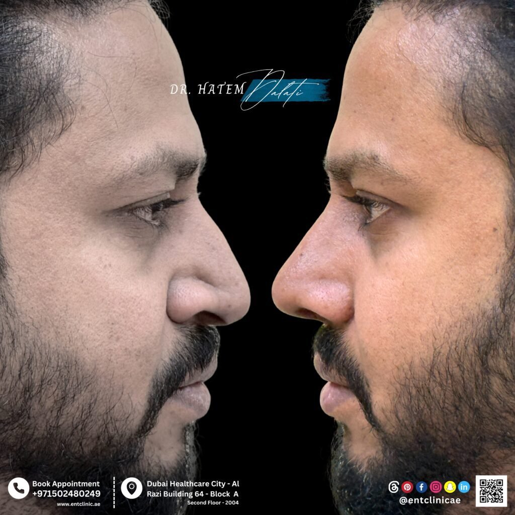 Before and after rhinoplasty for bulbous nose tip in Dubai by Dr. Hatem Dalati
