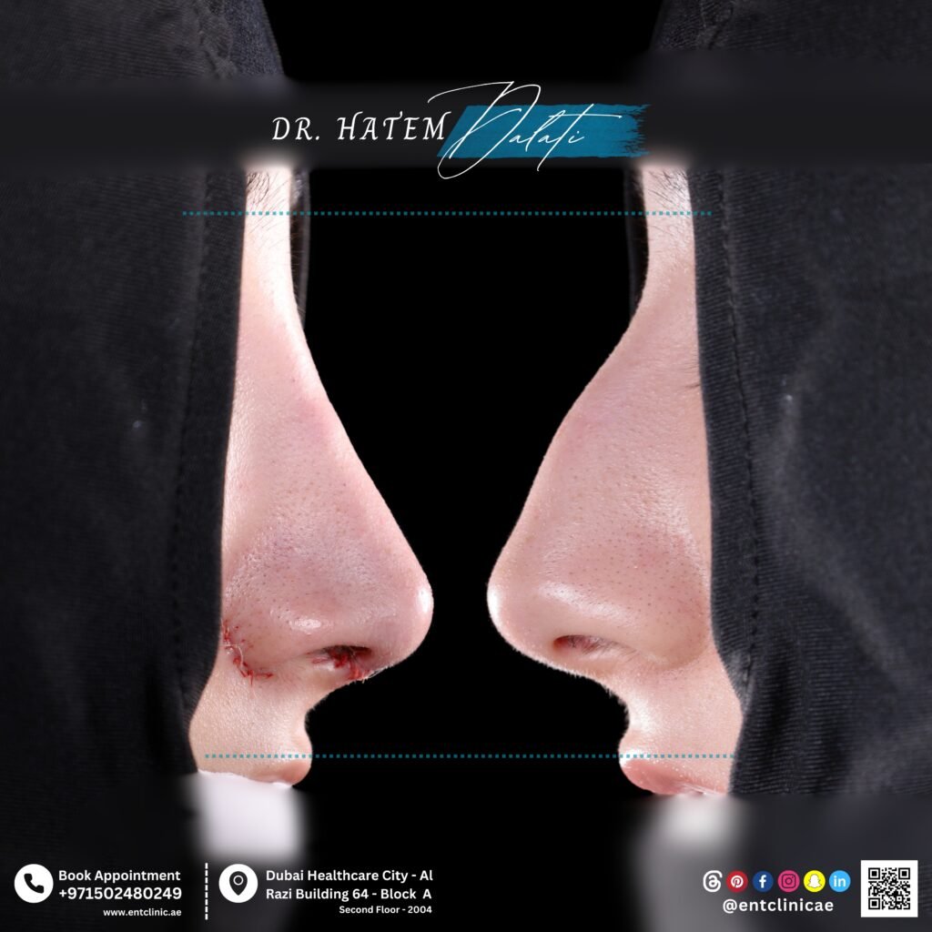 Before and after septorhinoplasty showing nasal symmetry and improved breathing