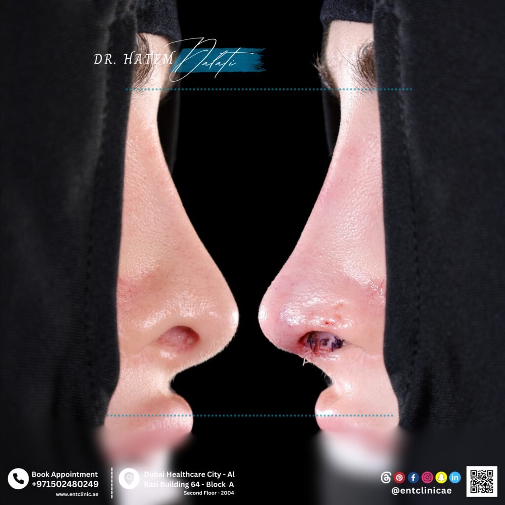 Revision nose job before and after showing correction of deformity and improved nasal shape in Dubai