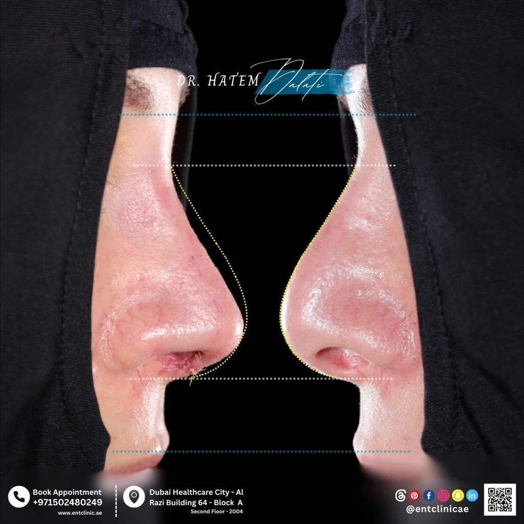 تجميل الأنف التصحيحي قبل و بعد عملية التجميل 