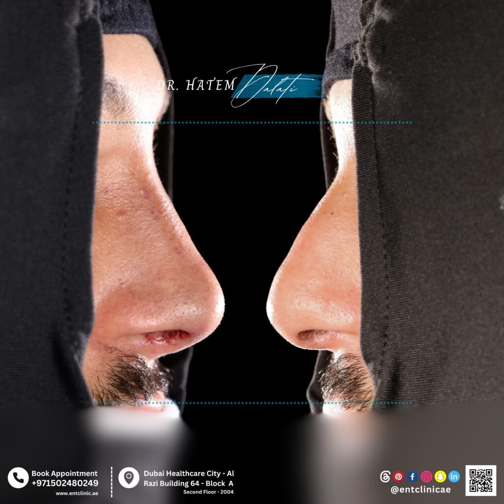 Male rhinoplasty before and after results in Dubai