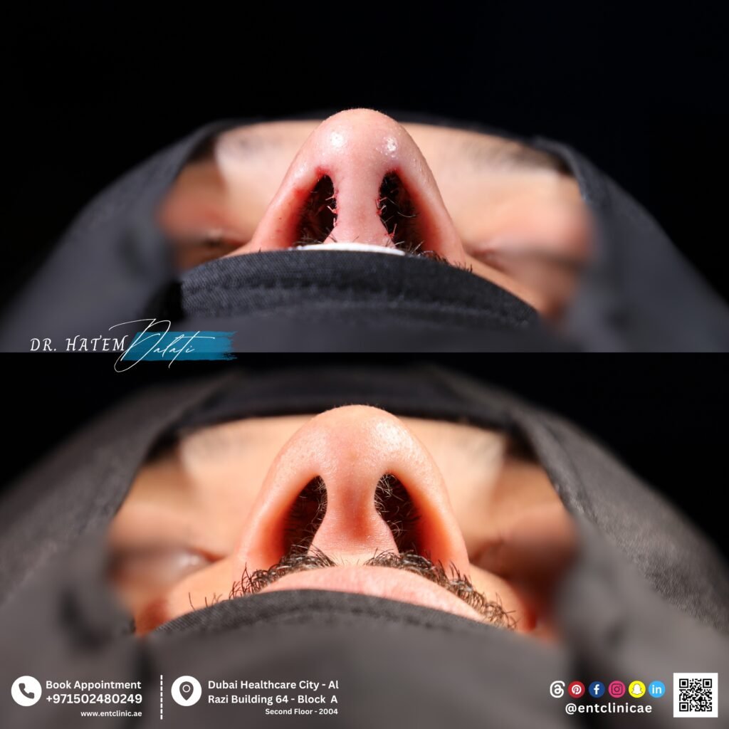 Male rhinoplasty nostril view showing wider nasal base, stronger tip support, and natural masculine contour after surgery