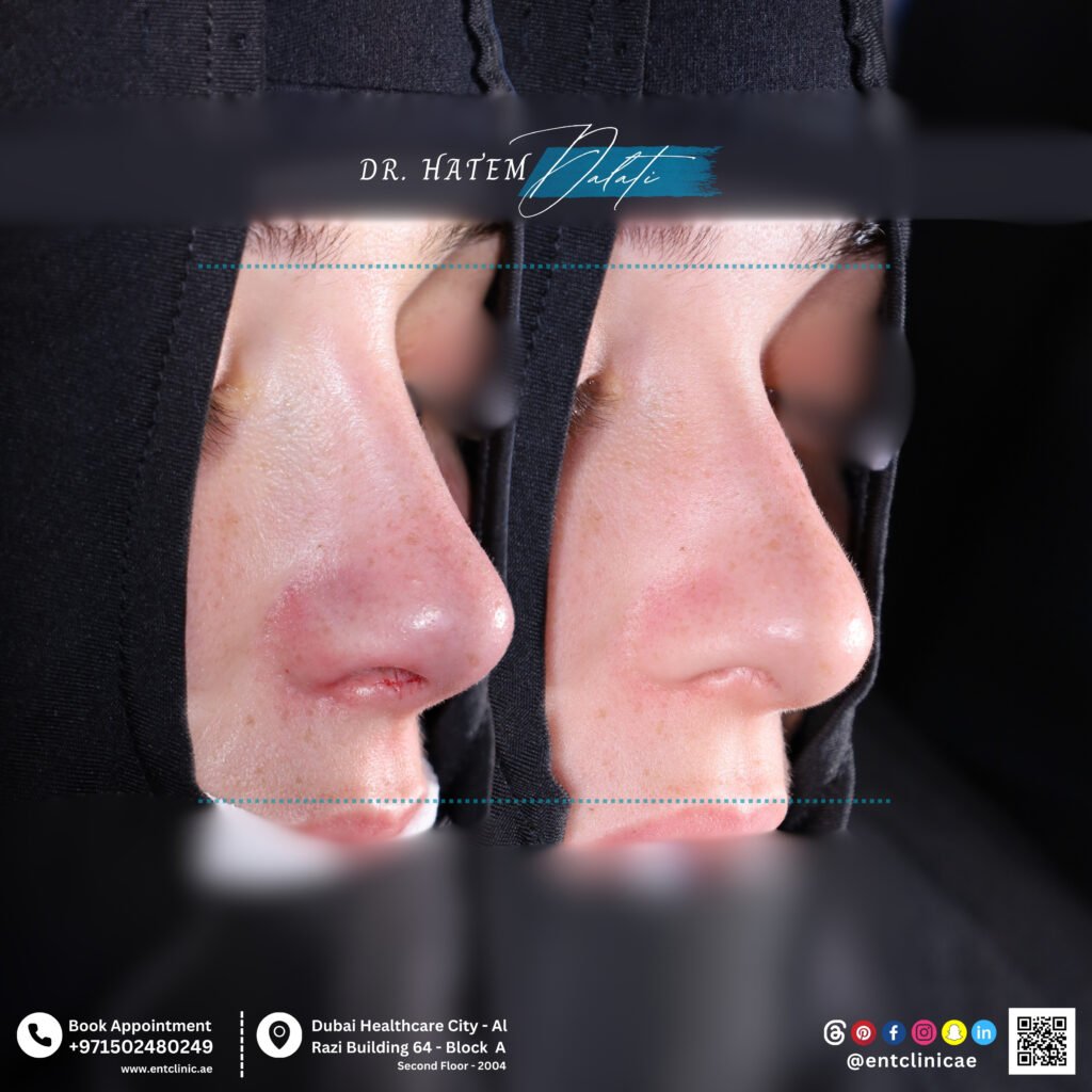 عملية تجميل الأنف