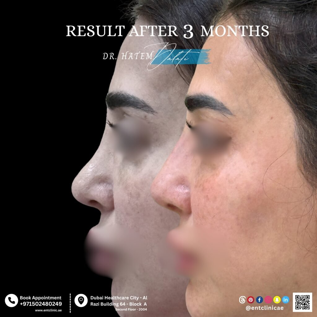 Before and after rhinoplasty correction of saddle nose deformity showing restored nasal bridge structure and improved profile in Dubai