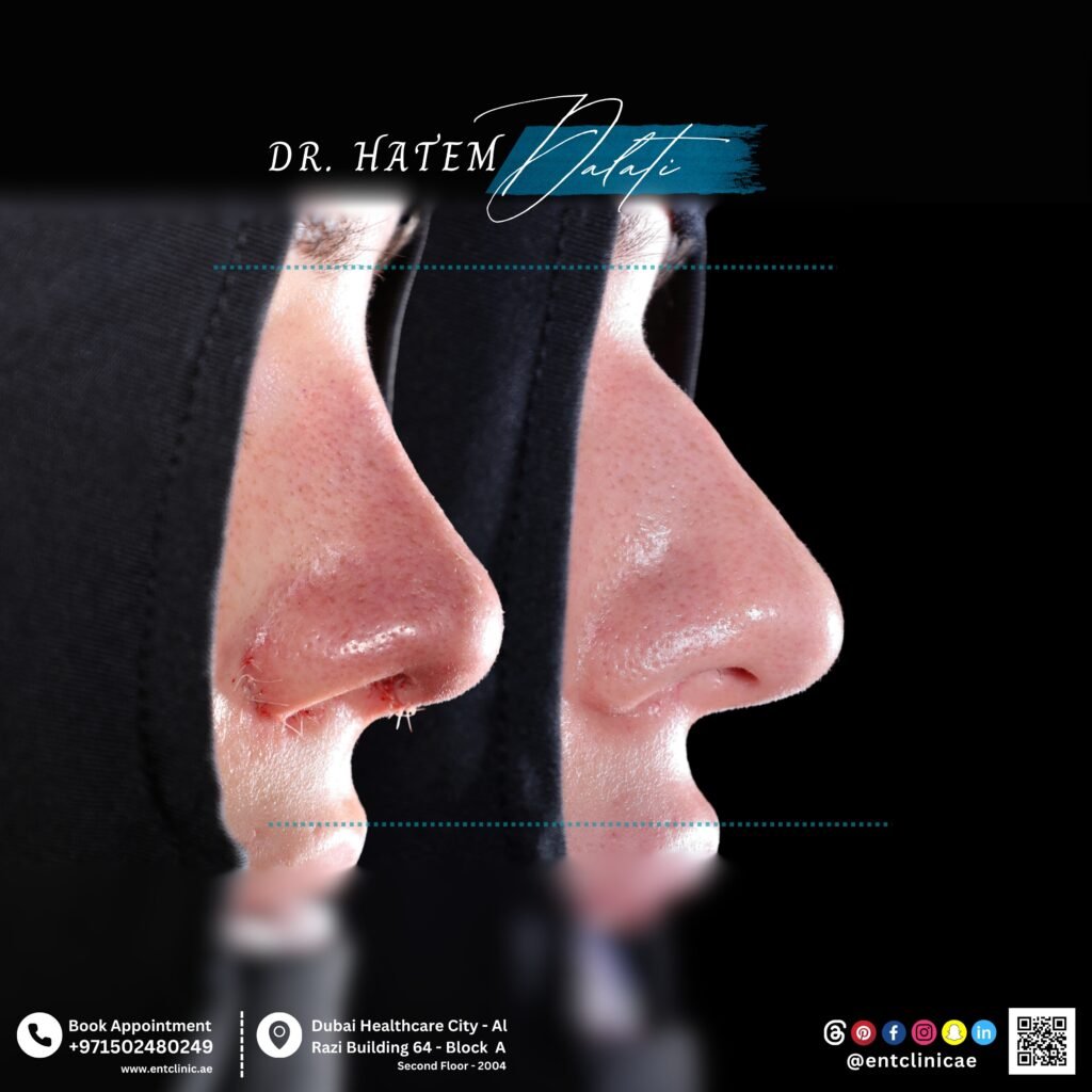 هل تقلّل حقن الكورتيزون التورّم بعد تجميل الأنف؟