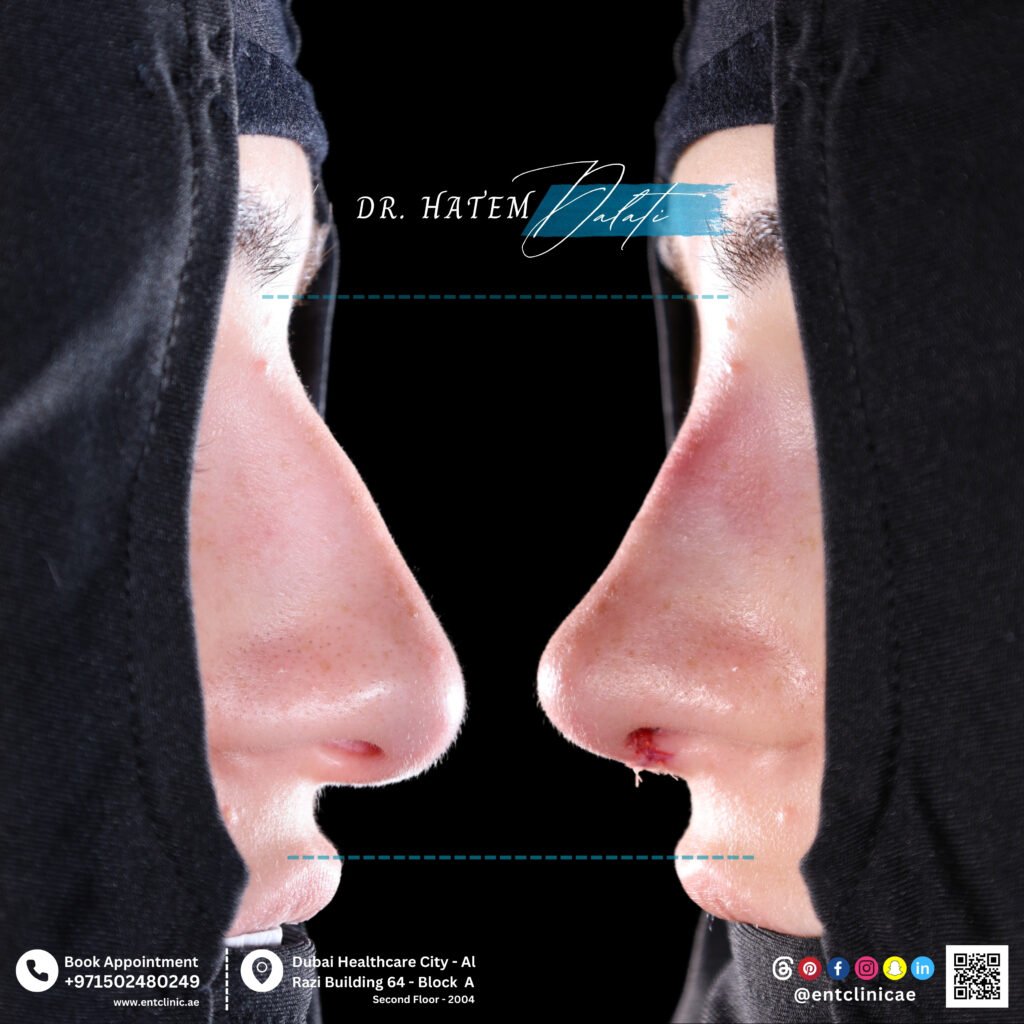 before and after correction of crooked nose