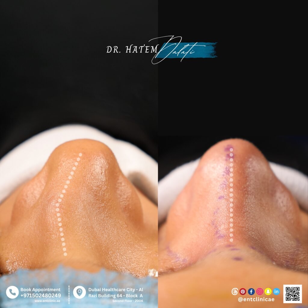 هل يمكن لعملية تجميل الأنف تصحيح اعوجاج الأنف، أو انحراف الحاجز الأنفي، أو حدبة الأنف في دبي؟ | د. حاتم دالاتي