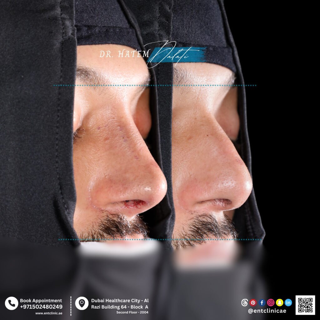 تجميل الأنف الطبيعي
قبل: حدبة ظهرية خفيفة مع جسر أنفي عريض، مخاط أنفي محتقن، تضخم ثنائي للقرنيات، وانحراف الحاجز الأنفي نحو اليمين. بعد: تم تنعيم الحدبة الظهرية، وتحسين جسر الأنف ليكون قويًا ودقيقًا، واستقامة الحاجز الأنفي، وتقليل حجم القرنيات، وتحسين تدفق الهواء الأنفي مع مظهر طبيعي رجولي.