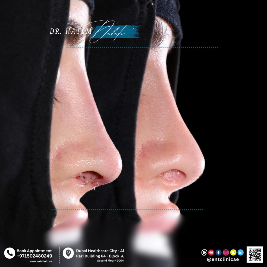 قبل عملية تجميل الأنف : انحراف شديد على شكل حرف S للحاجز الأنفي مع تضخم ثنائي للقرنيات
بعد عملية تجميل الأنف :  استقامة الحاجز الأنفي، وتقليل حجم القرنيات، واستعادة مجرى الهواء الأنفي مع تحسن التنفس والنوم، مع الحفاظ على مظهر أنفي طبيعي.