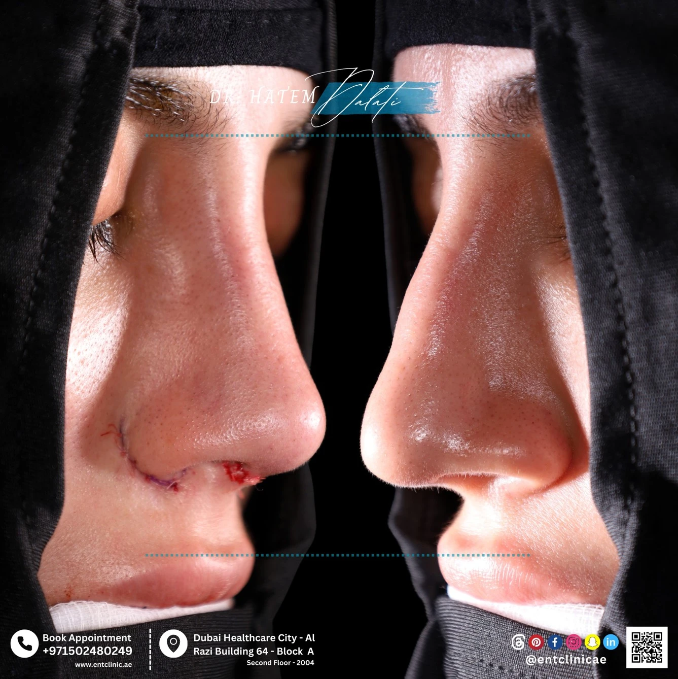 Dr. Hatem Dalati, a Dual-Board Certified ENT Consultant in Dubai, providing a specialized restorative assessment for complex revision rhinoplasty at the ENT Clinic of Excellence.
