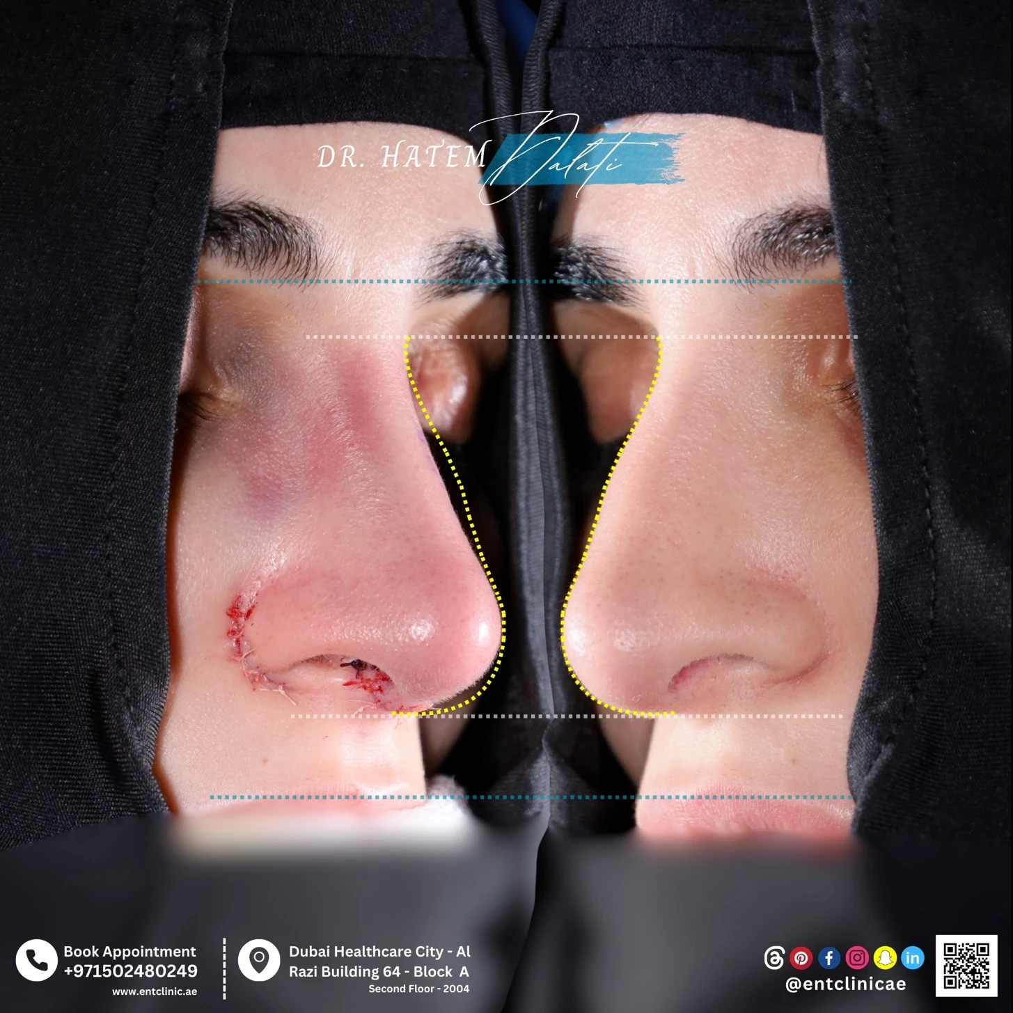 Restoring nasal airflow in Dubai: Dr. Hatem Dalati performing functional revision rhinoplasty to correct nasal valve collapse and chronic breathing problems following a failed surgery.