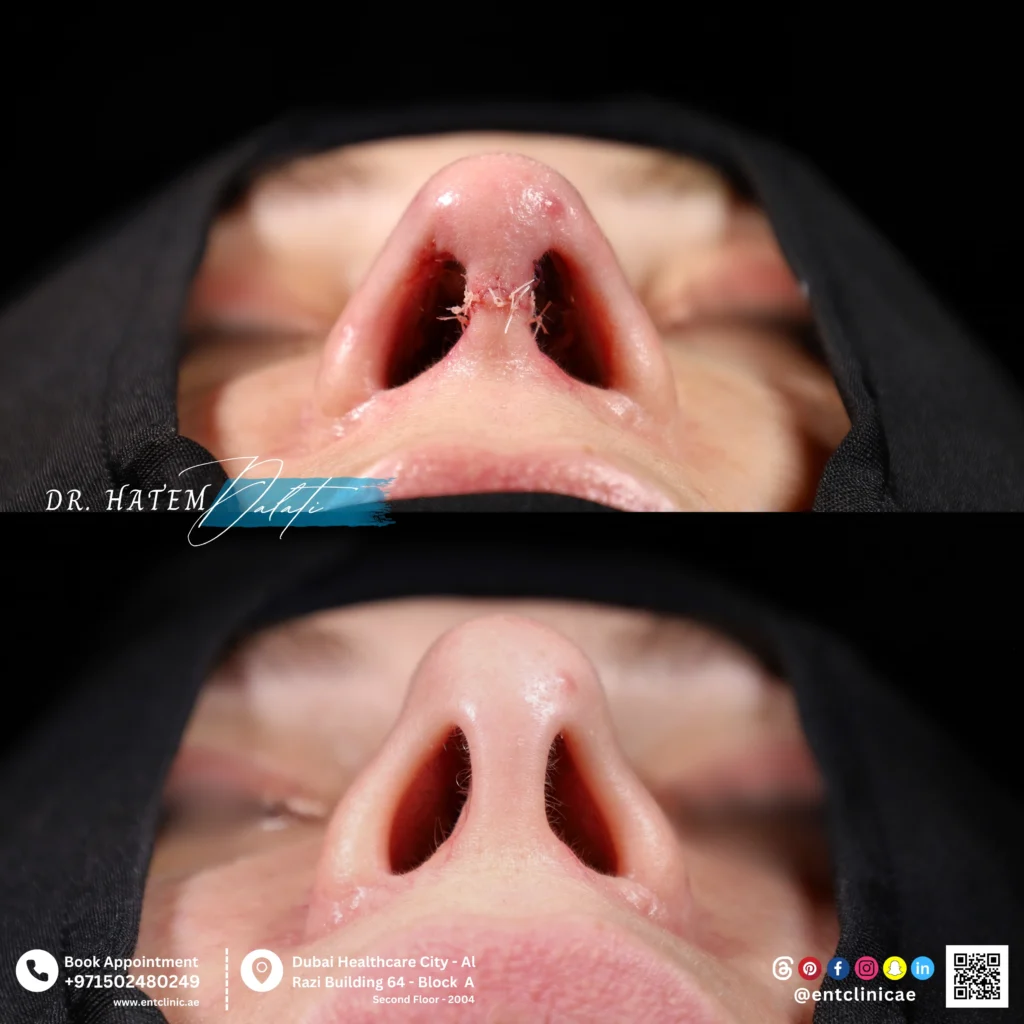 befoore and after base view revision rhinoplasty for polybeak deformity