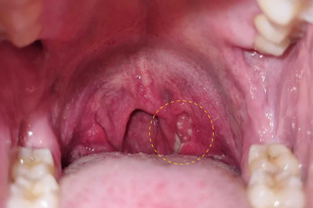 Tonsil stones visible in the tonsillar crypts of an open mouth