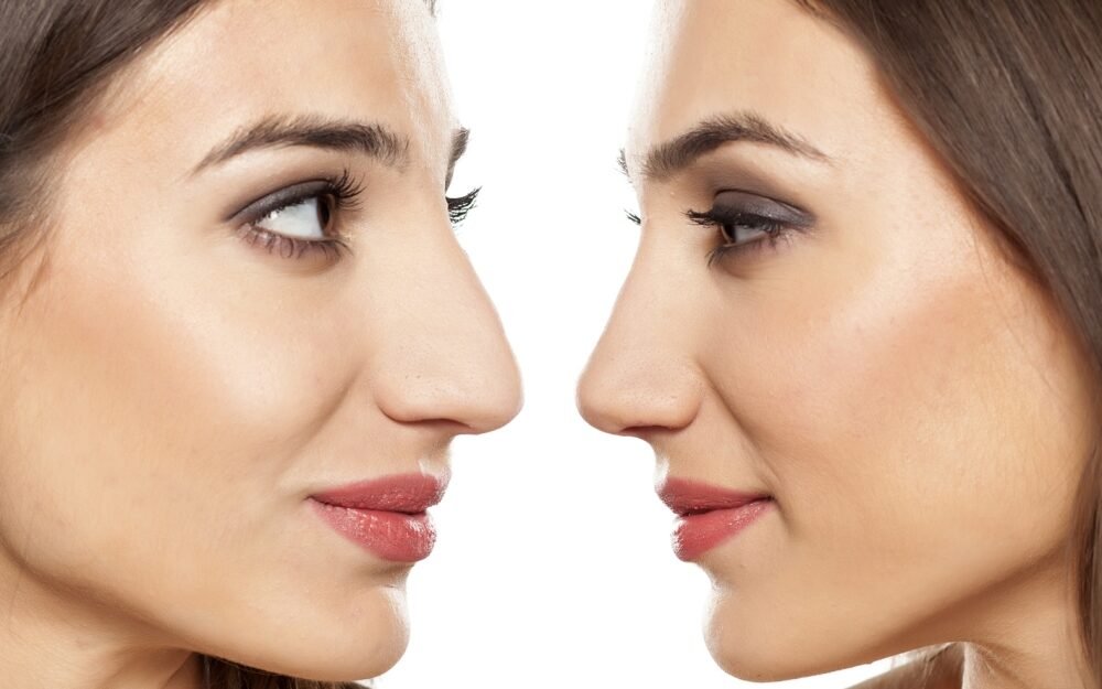 Choosing the Best Rhinoplasty Surgeon in Dubai for Revision Rhinoplasty Procedures