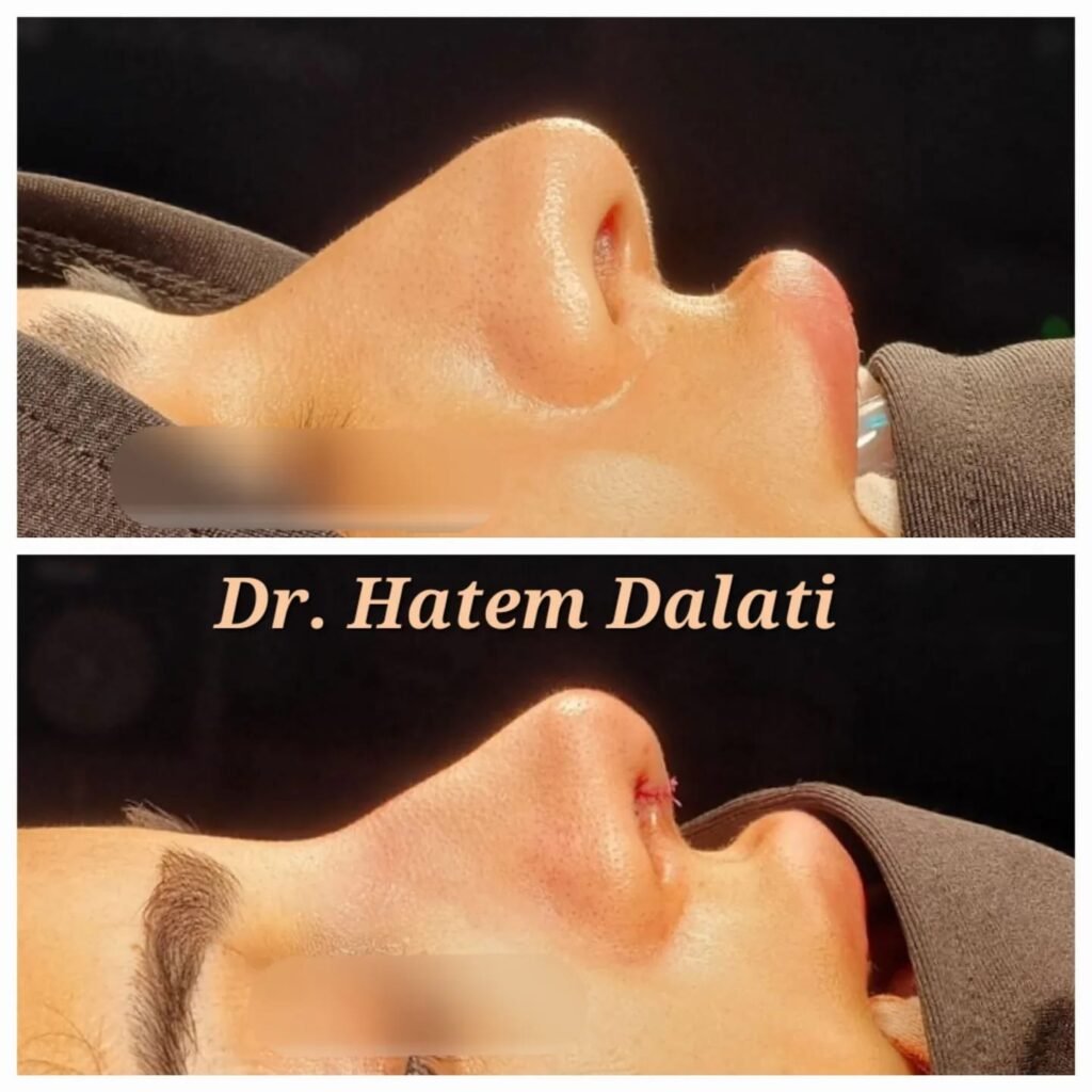 Transform Your Nose with the Best Rhinoplasty Surgeon in Dubai