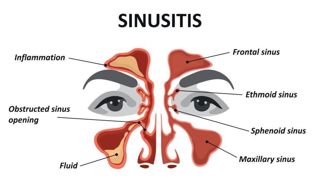 Managing Sinusitis: Tips for Relief