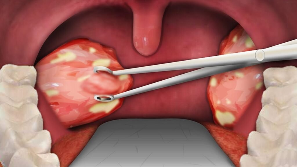 Choosing the Best ENT Consultant in Dubai for Tonsillectomy and Adenoidectomy