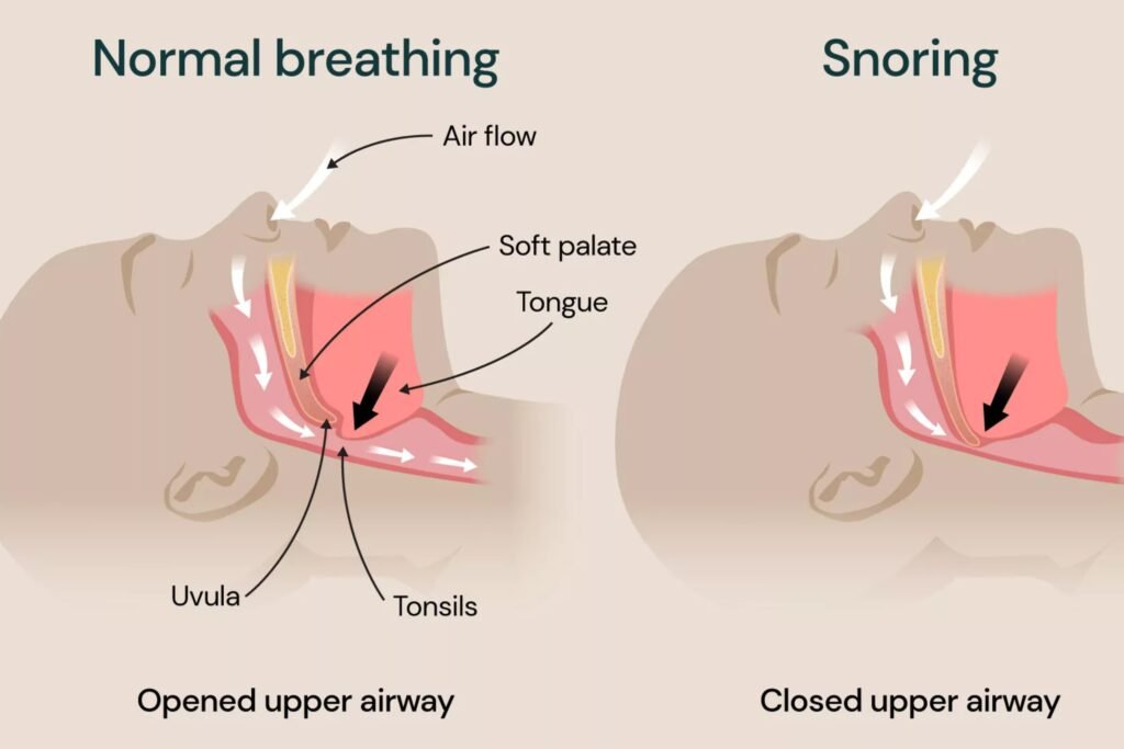 الشخير وانسداد الأنف – أفضل استشاري أنف وأذن وحنجرة في دبي –