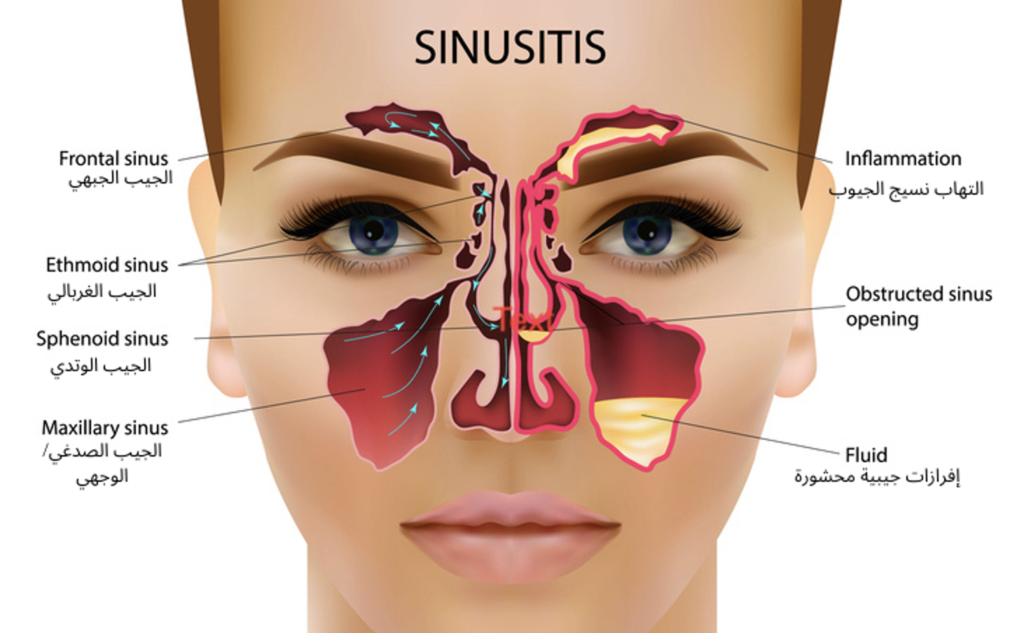 التهاب الجيوب الأنفية المزمن – أفضل أطباء الأنف والأذن والحنجرة في دبي –