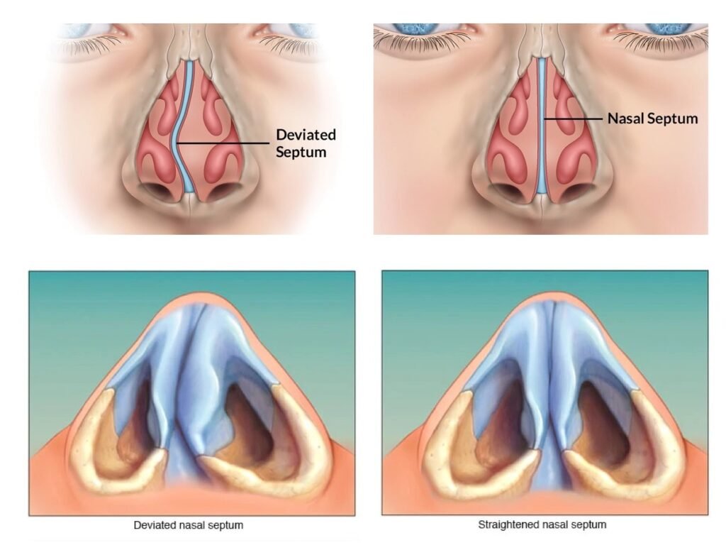 The Relationship Between Rhinoplasty and Septum Deviation Correction