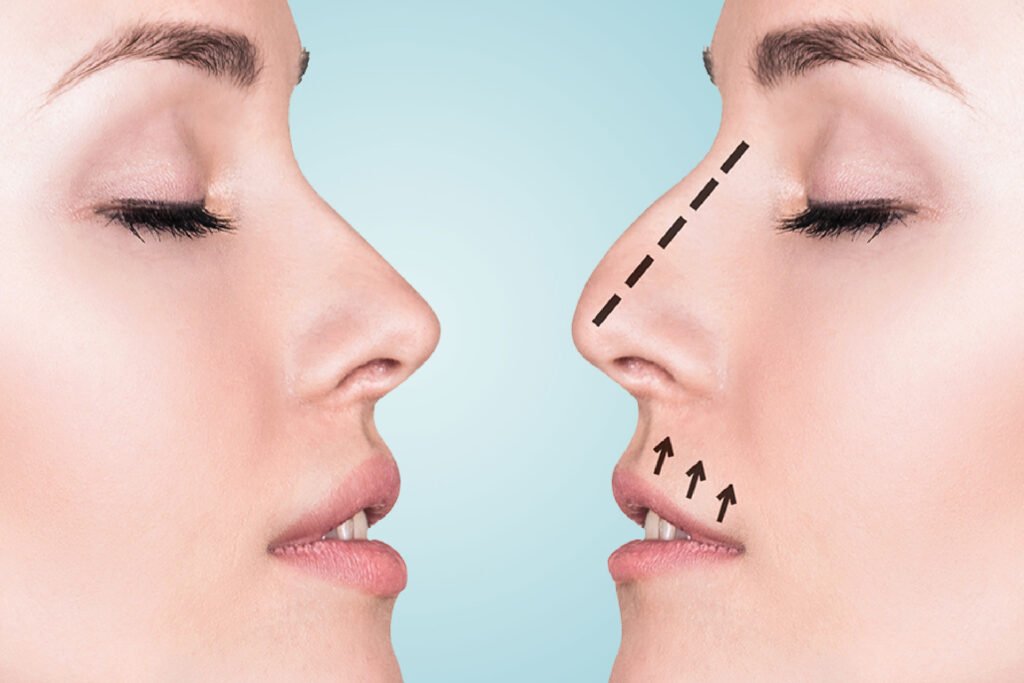 Debunking Common Misconceptions About Rhinoplasty