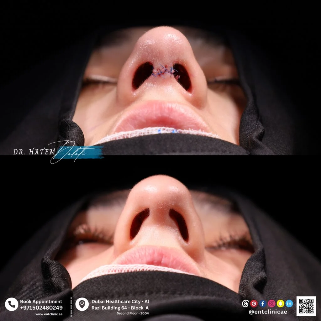 الندبات بعد عملية تجميل الأنف: التليّف، الشفاء، وهل تترك عملية تجميل الأنف آثارًا دائمة؟ | دبي