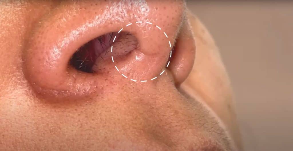 How to Handle Scar Tissue After Rhinoplasty