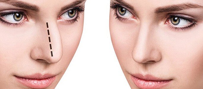 Rhinoplasty: Open or Closed? Choosing the Best Surgeon