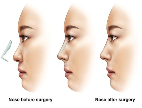 تطور عمليات تجميل الأنف: من العصور القديمة إلى التقنيات الحديثة