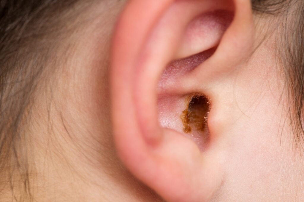 The Risks of Removing Earwax with Ear Picks: Expert Advice from the Best ENT Doctor in Dubai