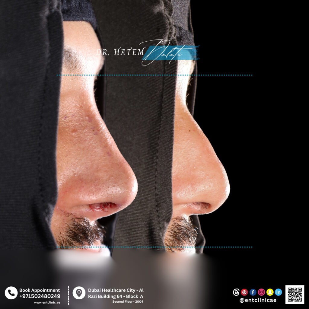 مريض ذكر قبل وبعد عملية رأب الحاجز الأنفي و تجميل الأنف، يُظهر تحسنًا في تماثل الأنف وتحسينًا في بنيته.