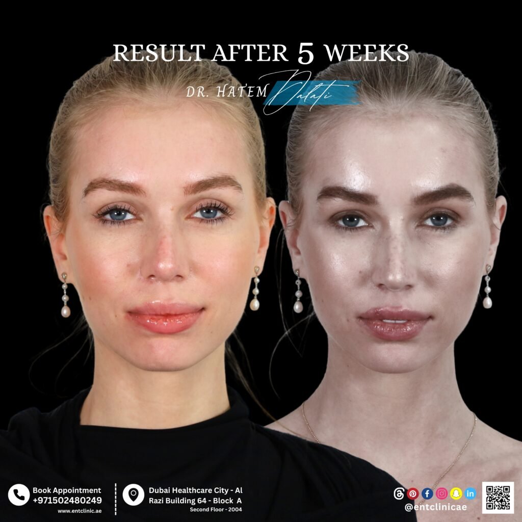 before and after subtle and natural rhinoplasty results