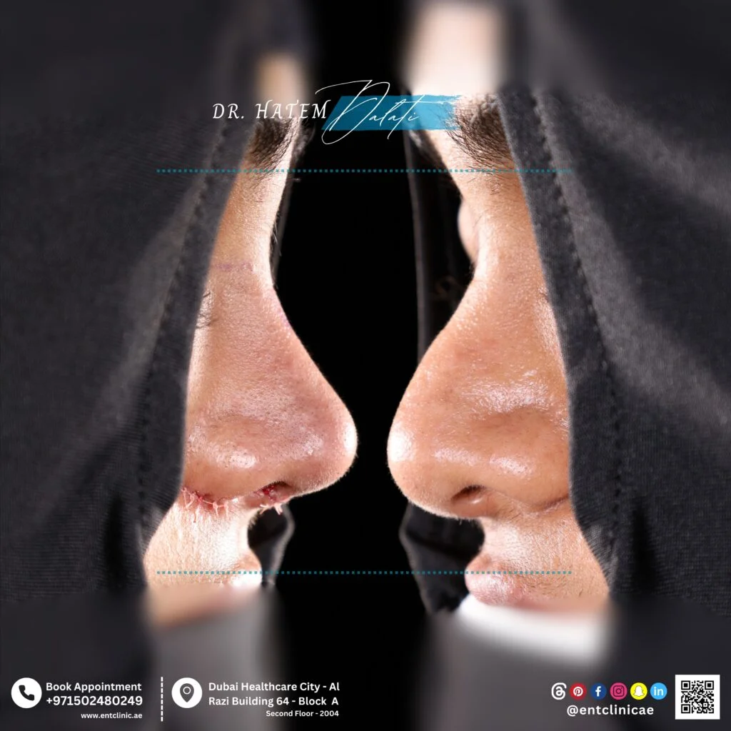 نتيجة حقيقية لمريض تُظهر كيف يُحسّن تجميل الأنف العرقي شكل الأنف مع الحفاظ على التناغم الطبيعي للوجه والهوية الثقافية بواسطة الدكتور حاتم دالاتي.