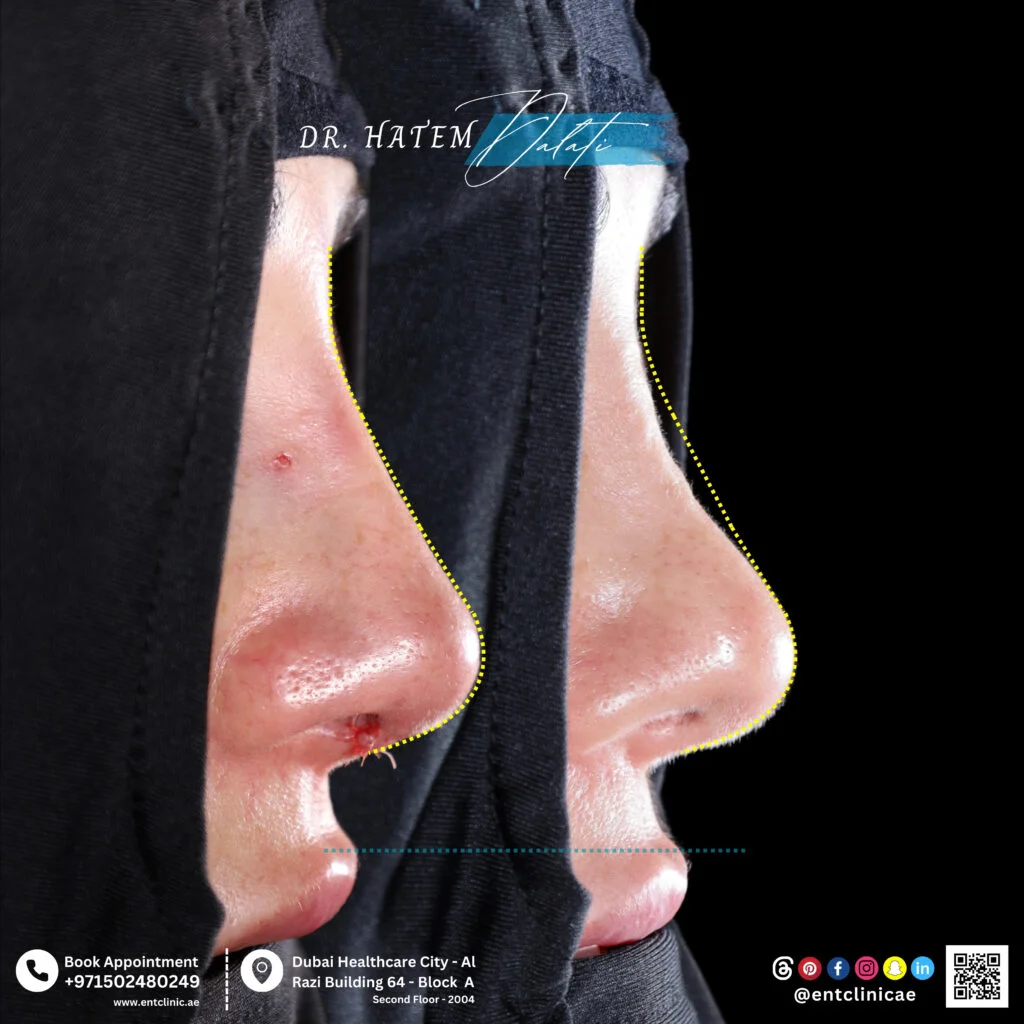 تكلفة تجميل الأنف في دبي - تجميل الأنف التصحيحي - تكلفة ترميم الأنف في دبي