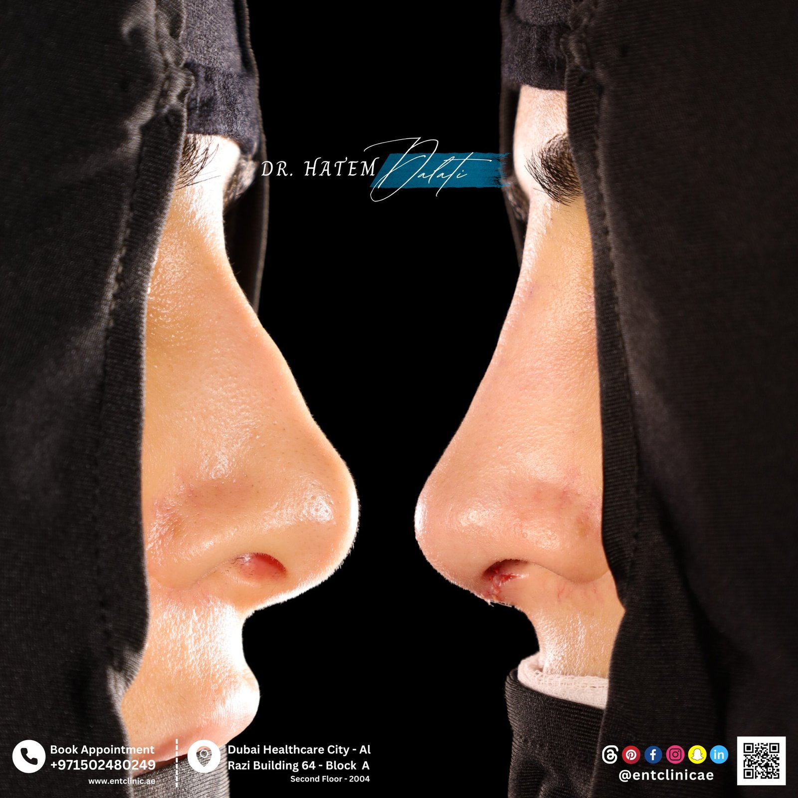 DR HATEM DALATI RHINOPLASTY NOSE JOB REVISION DUBAI UAE NATURAL LOOK PRICE ENT CONSULTANT SURGEON SURGERY