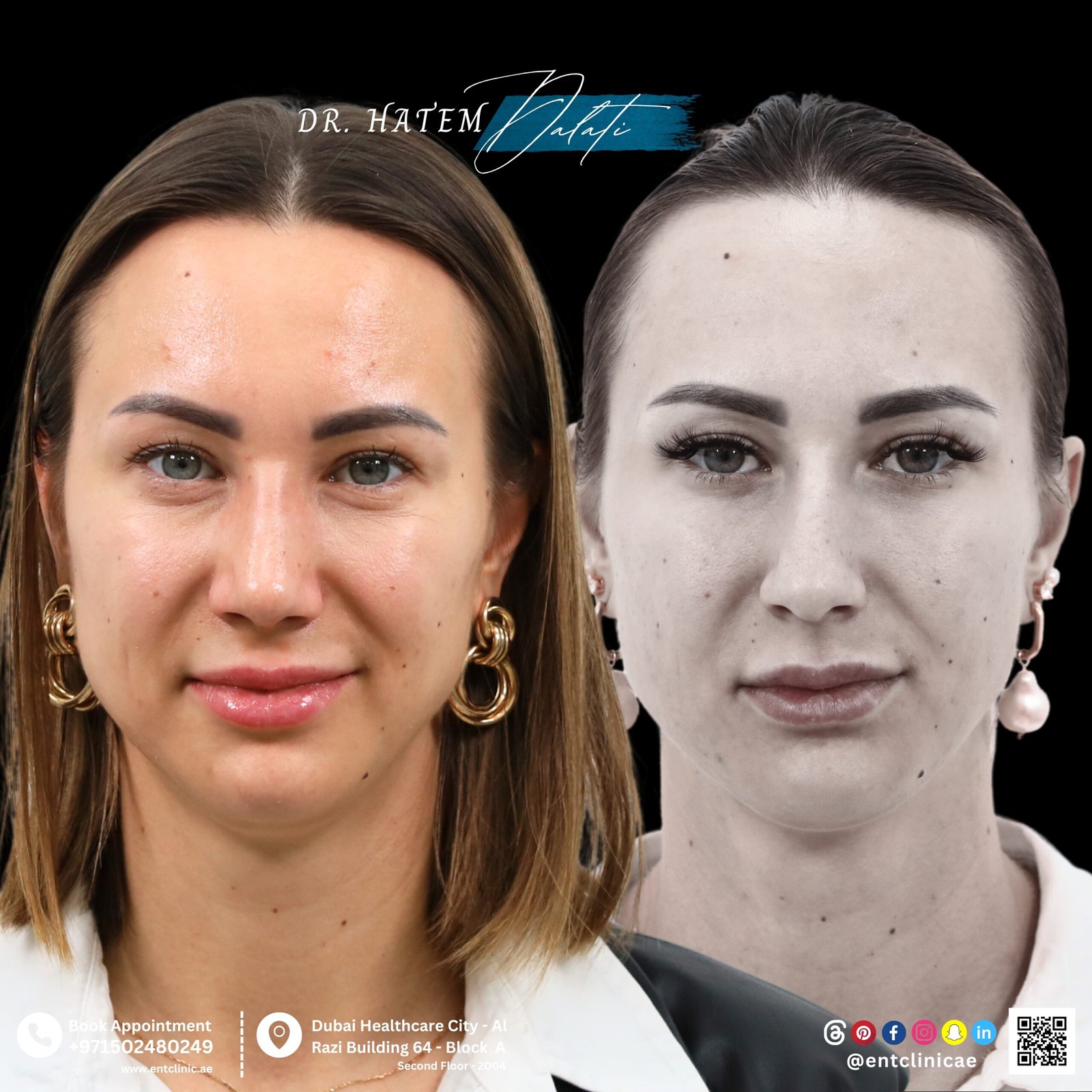 DR HATEM DALATI RHINOPLASTY NOSE JOB REVISION DUBAI UAE NATURAL LOOK PRICE ENT CONSULTANT SURGEON SURGERY