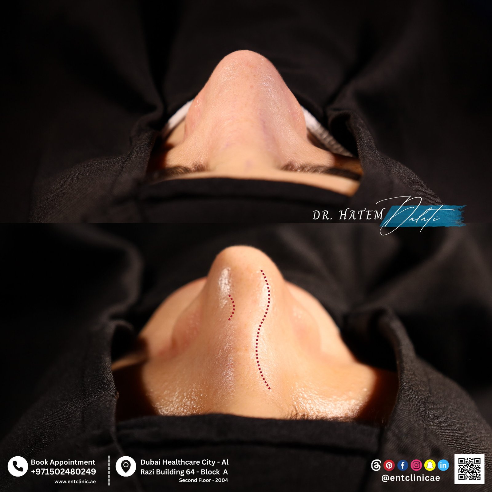 DR HATEM DALATI RHINOPLASTY NOSE JOB REVISION DUBAI UAE NATURAL LOOK PRICE ENT CONSULTANT SURGEON SURGERY