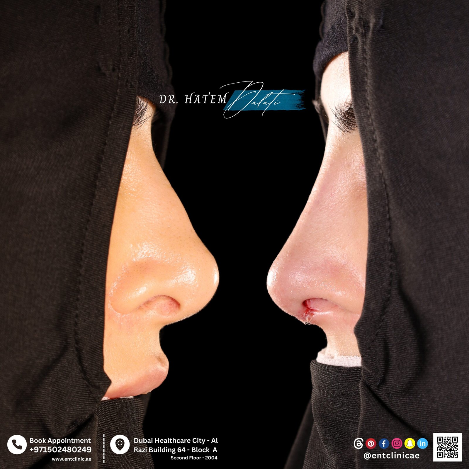 DR HATEM DALATI RHINOPLASTY NOSE JOB REVISION DUBAI UAE NATURAL LOOK PRICE ENT CONSULTANT SURGEON SURGERY