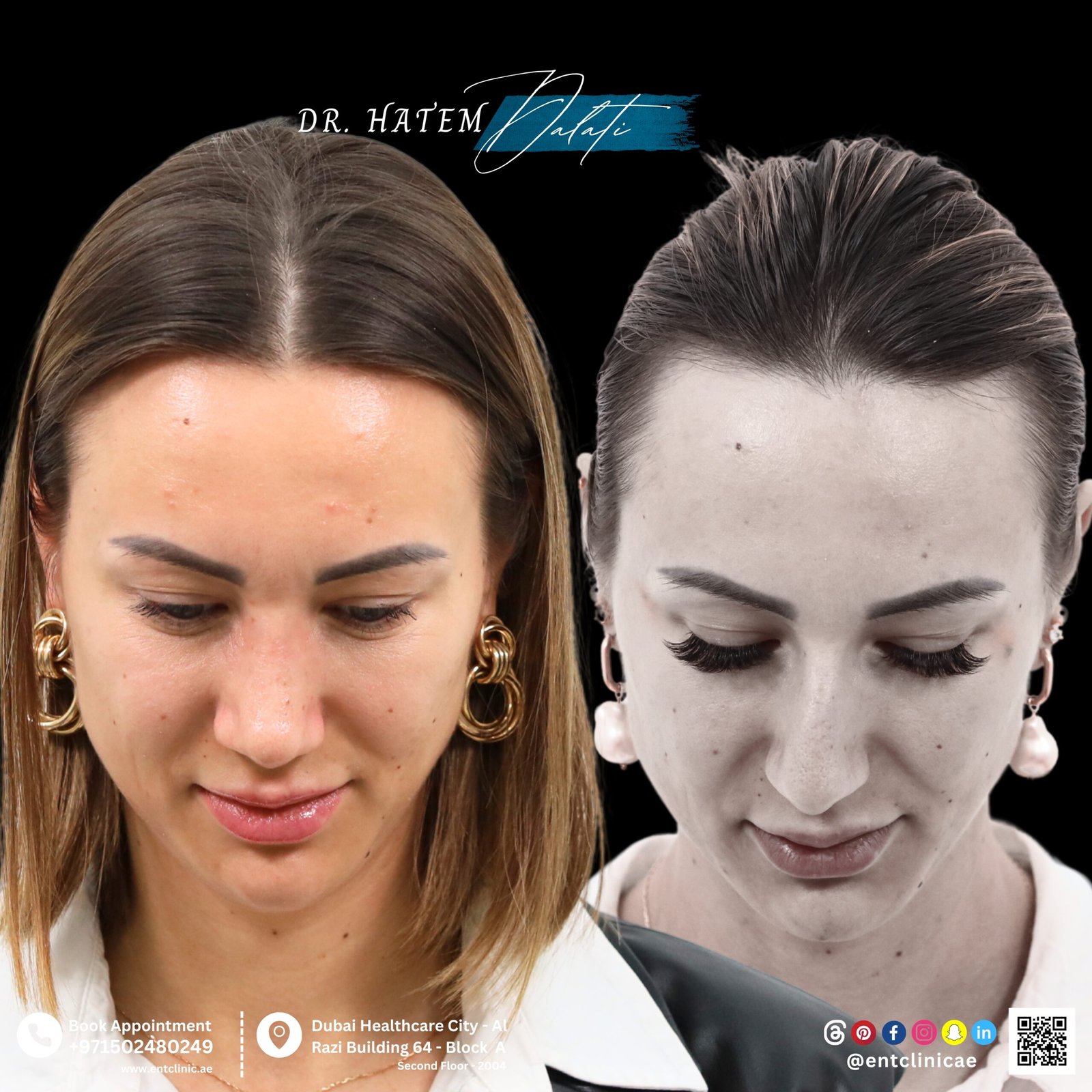DR HATEM DALATI RHINOPLASTY NOSE JOB REVISION DUBAI UAE NATURAL LOOK PRICE ENT CONSULTANT SURGEON SURGERY
