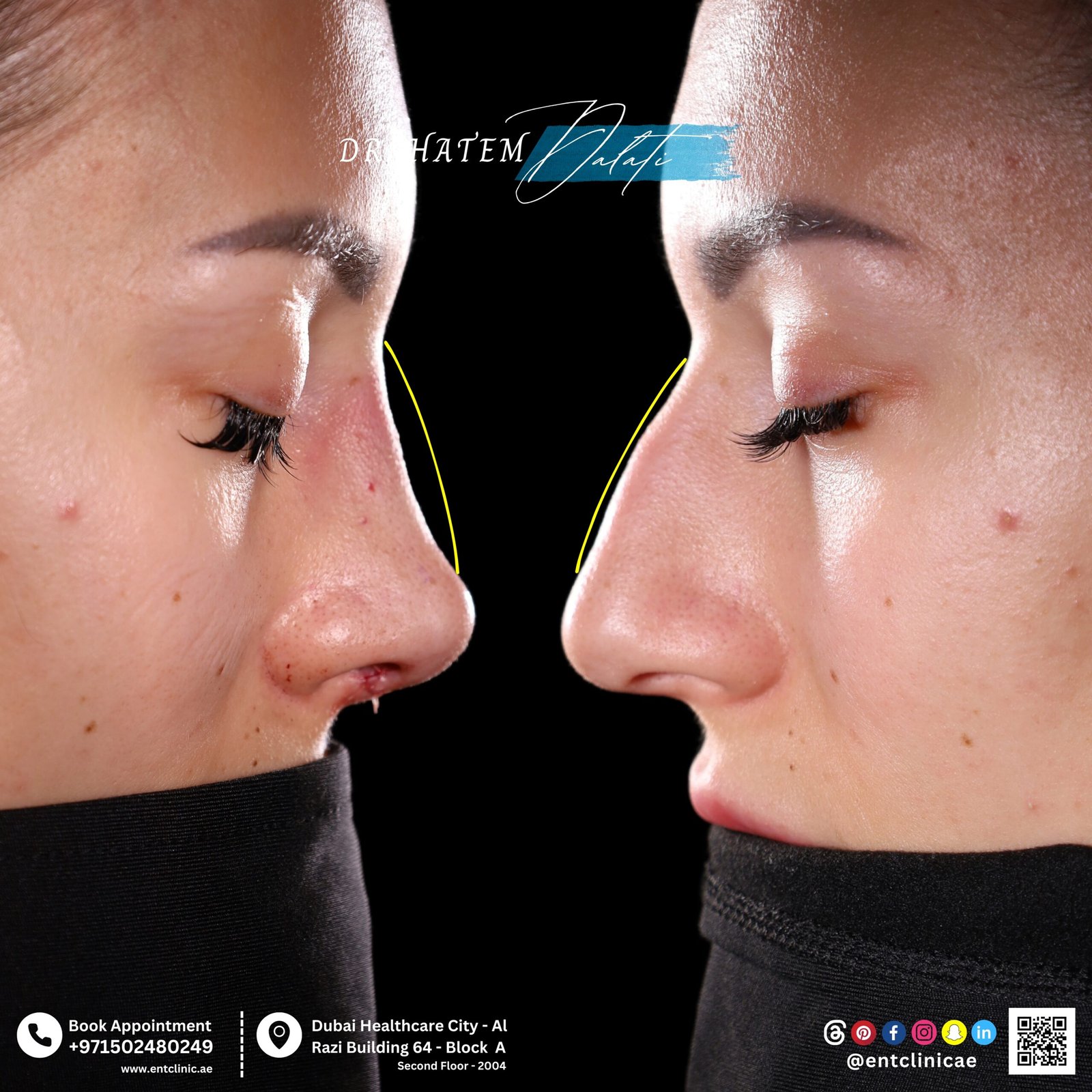 DR HATEM DALATI RHINOPLASTY NOSE JOB REVISION DUBAI UAE NATURAL LOOK PRICE ENT CONSULTANT SURGEON SURGERY