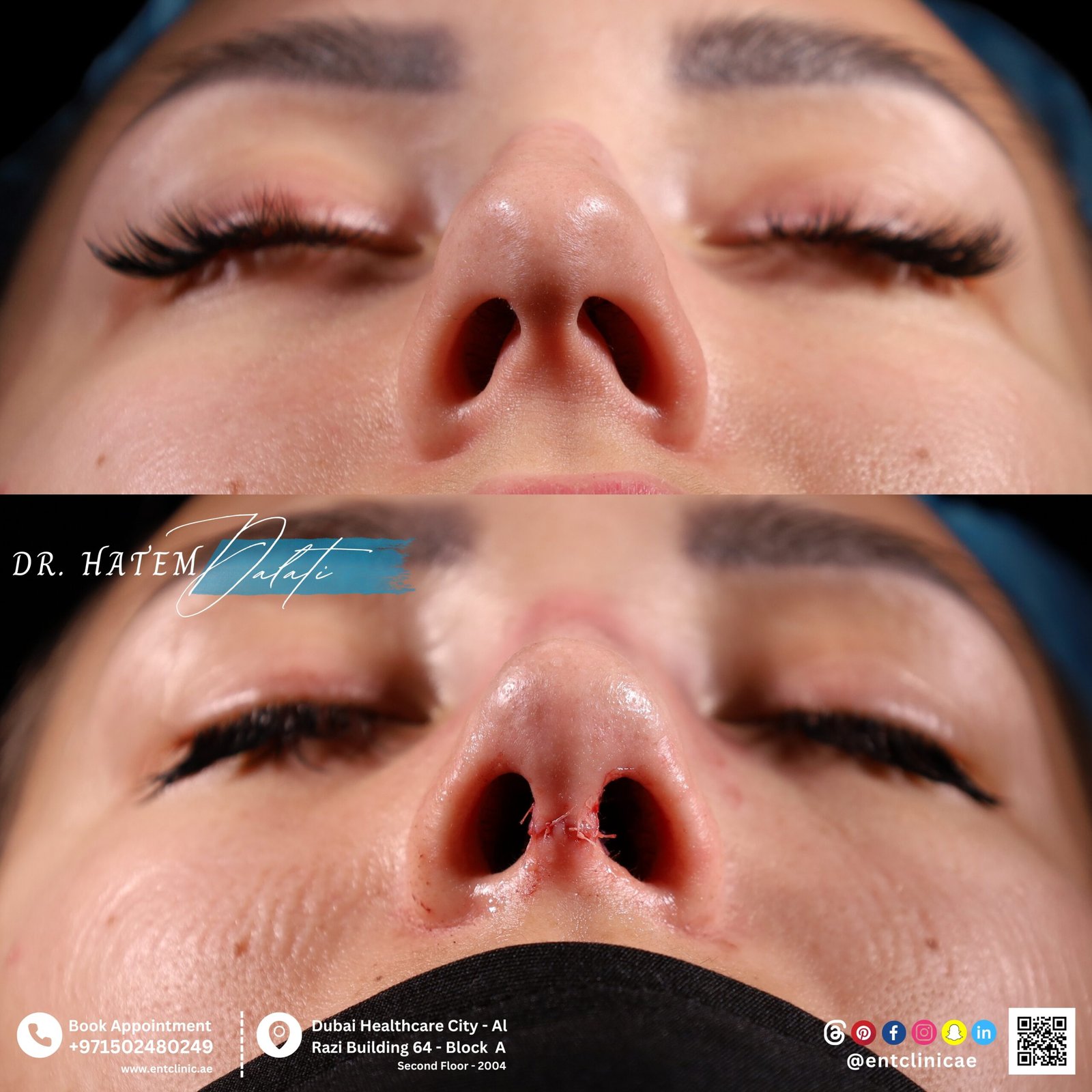 DR HATEM DALATI RHINOPLASTY NOSE JOB REVISION DUBAI UAE NATURAL LOOK PRICE ENT CONSULTANT SURGEON SURGERY
