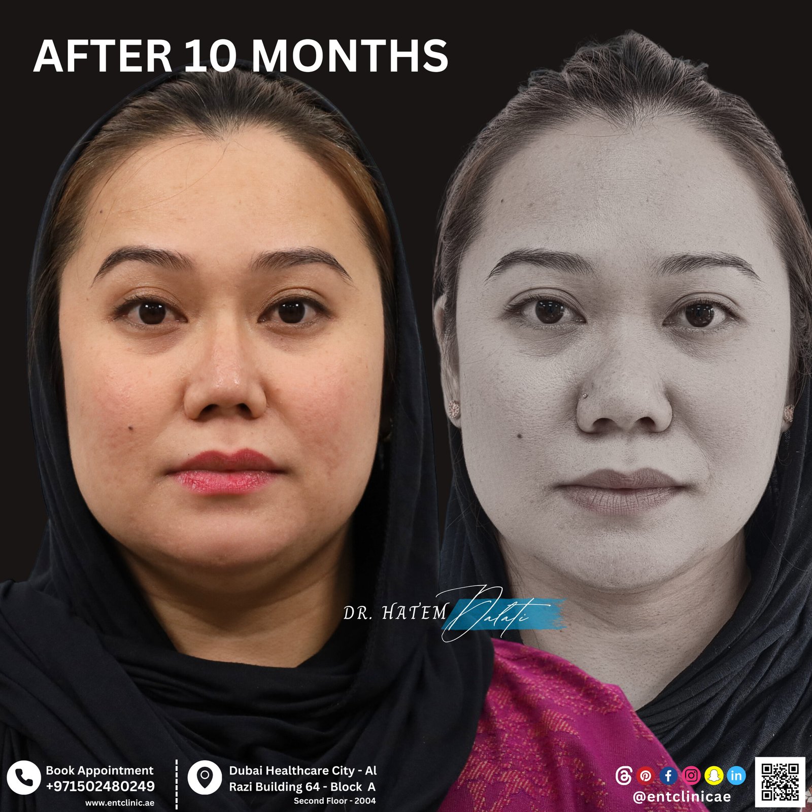 DR HATEM DALATI RHINOPLASTY NOSE JOB REVISION DUBAI UAE NATURAL LOOK PRICE ENT CONSULTANT SURGEON SURGERY